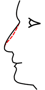 remboursement de la rhinoplstie