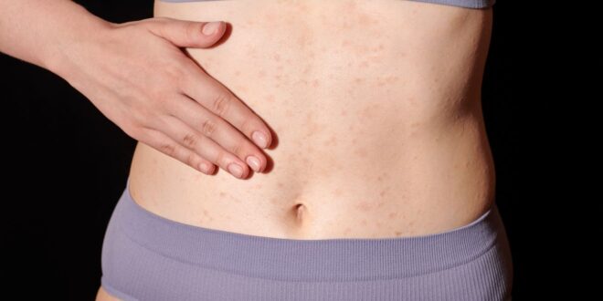 Boutons rouges sur le corps : causes et traitements