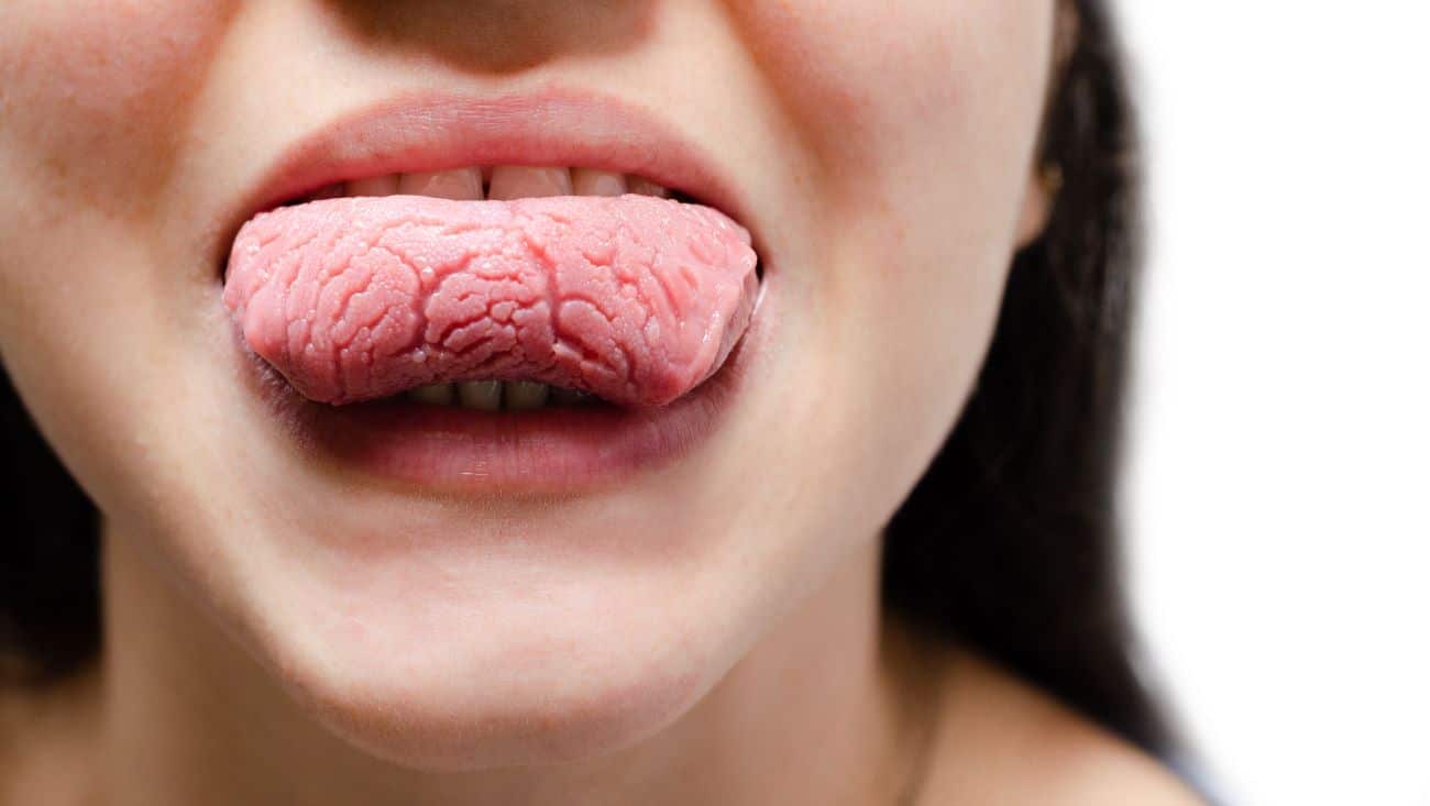 Langue fissurée causes, symptômes, diagnostic et traitement