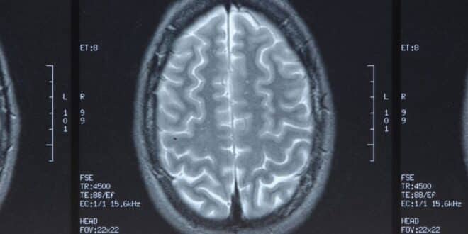Atrophie cortico sous-corticale : causes, symptômes et traitement