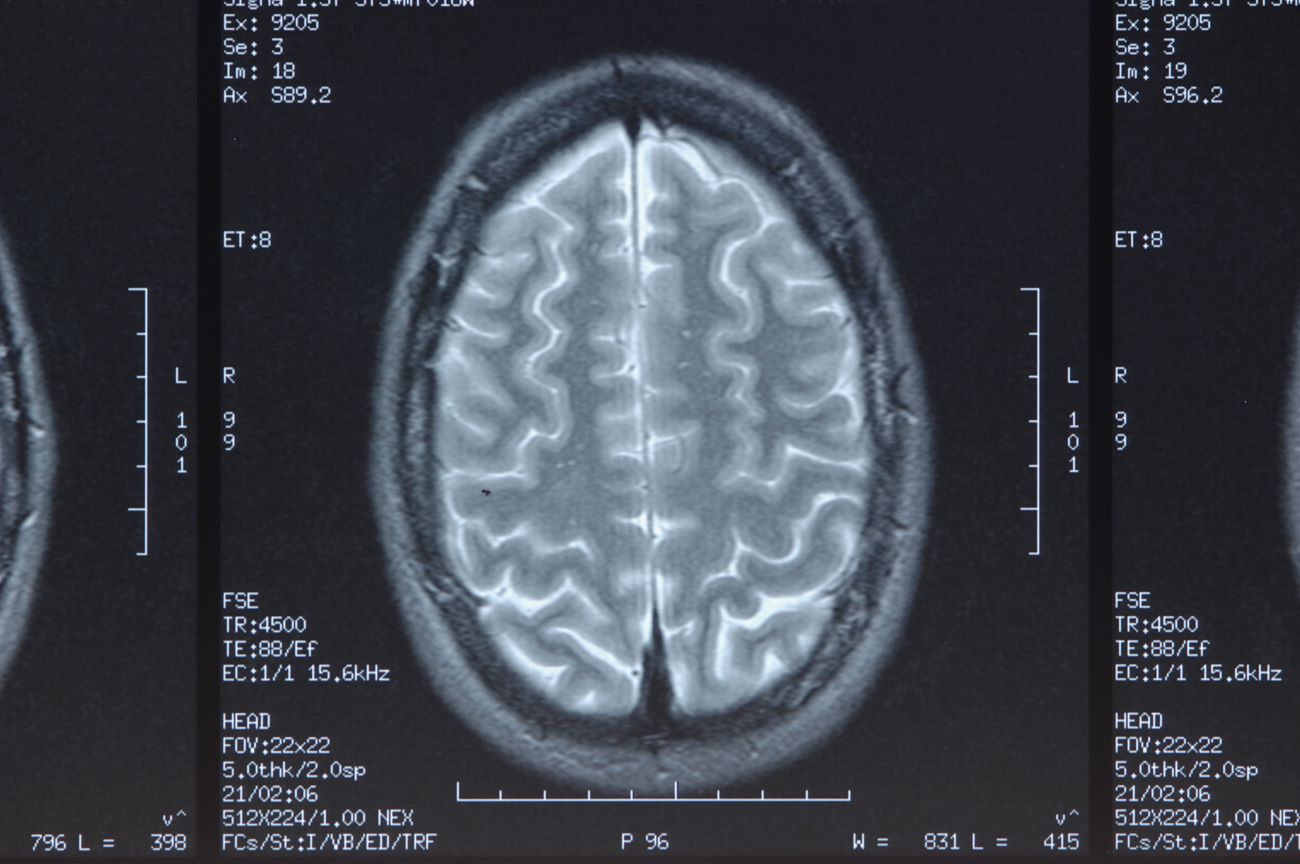 Atrophie cortico sous-corticale : causes, symptômes et traitement ...