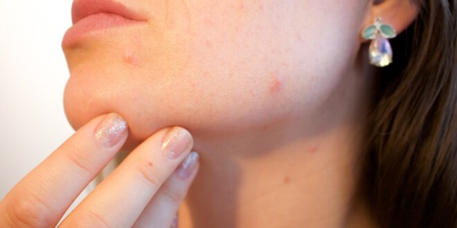 Cicatrices d’acné : Quels sont les différents types ? Comment les traiter ?